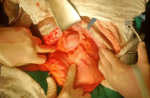 hérnia: obstrução intestinal por defeito omental